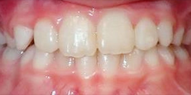 Patient's straightened smile after orthodontic treatment with Dr. Feagin