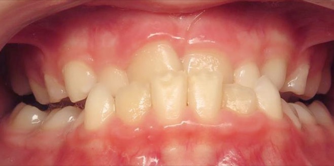 Patient's smile before orthodontic treatment with Dr. Feagin