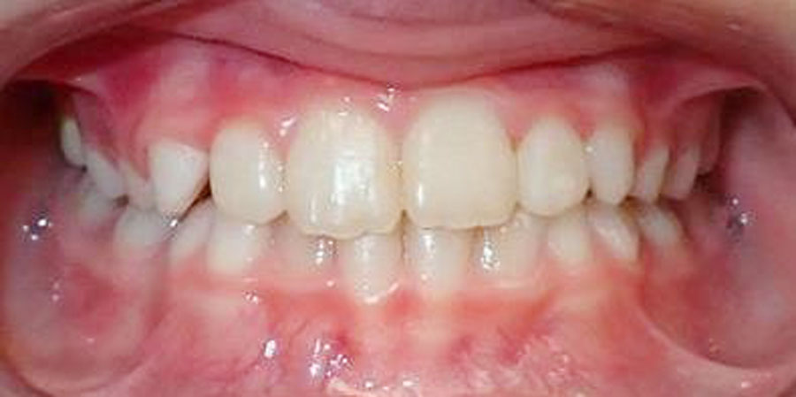 After treatment